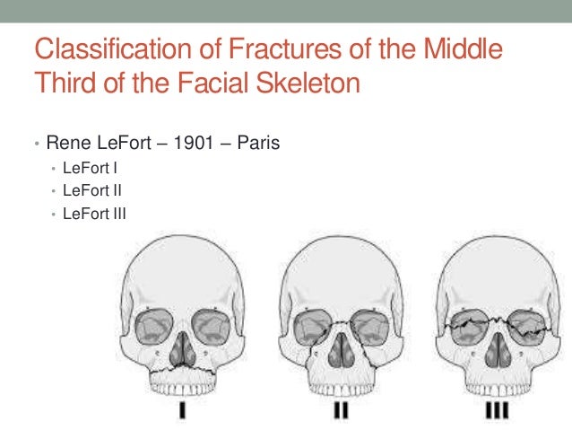 Facial fracture classification galleries
